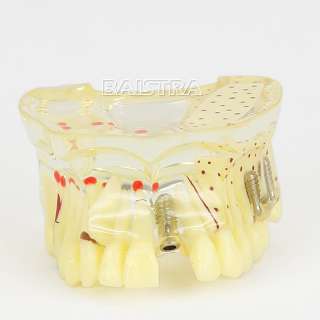 Dental Study Teaching Model Teeth Implant Model Osteoporosis and 